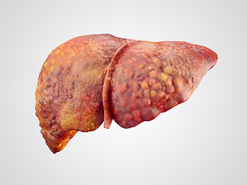 The Causes Of Cirrhosis in the Liver?