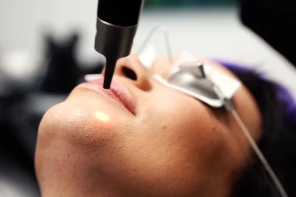 Pico Laser treatment for acne scars