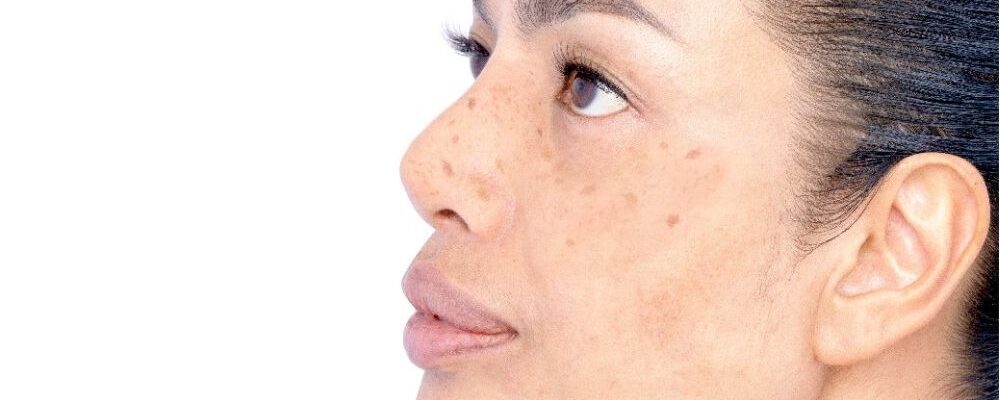 Pico laser procedure for acne scars