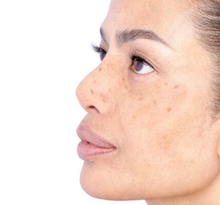 Pico laser procedure for acne scars