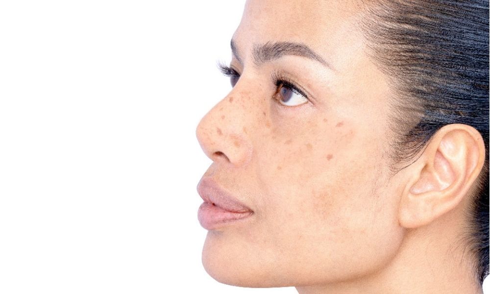 Zap Acne Scars Away with Precision Pico Laser Treatments